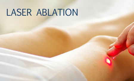 laser ablation - British Vein Institute